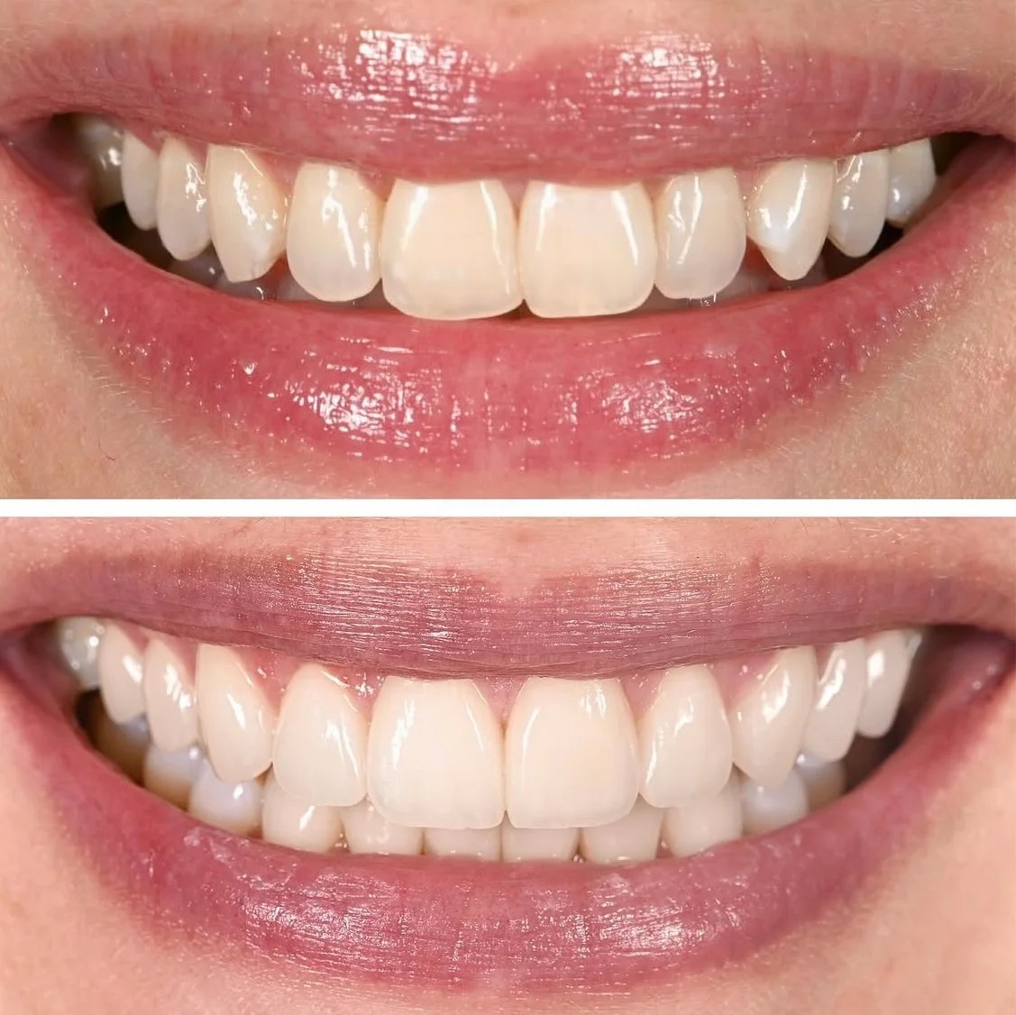 After treatment: artistic composite bonding used to repair localized structural damage, achieving an undetectable margin and perfectly mimicking the translucency and texture of the adjacent natural enamel.